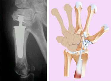 Chirurgie classique de la rhizarthrose