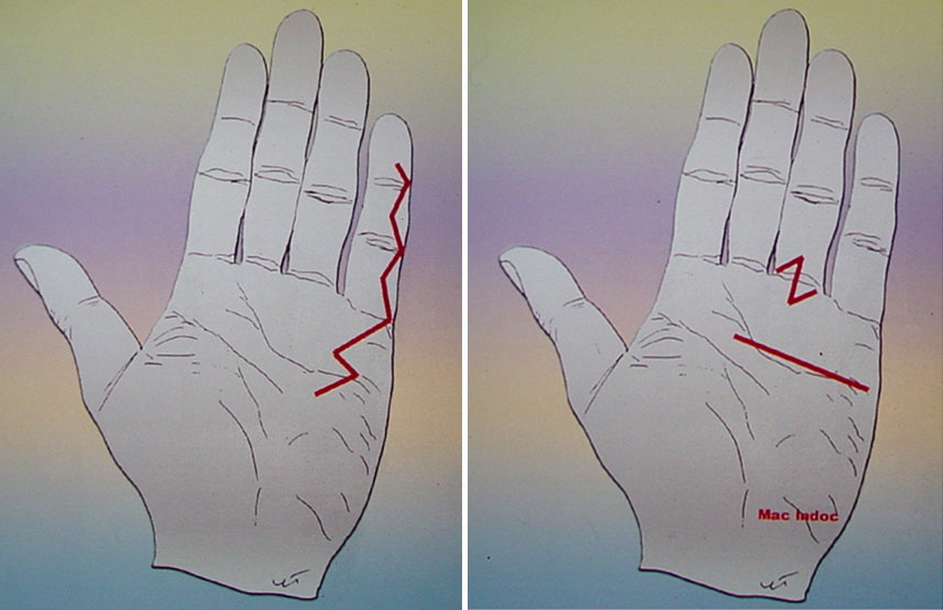 Exemples d'incisions maladie de Dupuytren