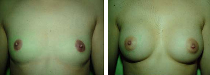 Photo d'augmentation mammaire avant après