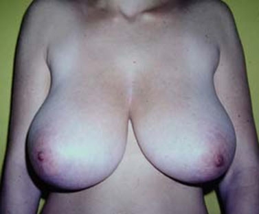 Exemple d'hypertrophie mammaire