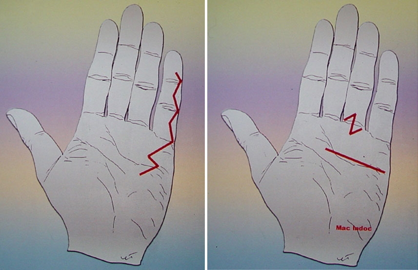 Exemples d'incisions maladie de Dupuytren Exemples d'incisions maladie de Dupuytren