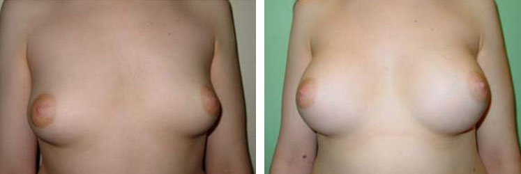Photo d'augmentation mammaire avant après Photo d'augmentation mammaire avant après