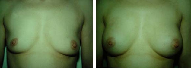 Photo d'augmentation mammaire avant après