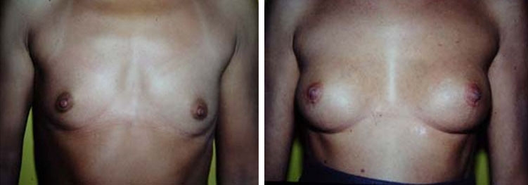 Photo d'augmentation mammaire avant après Photo d'augmentation mammaire avant après