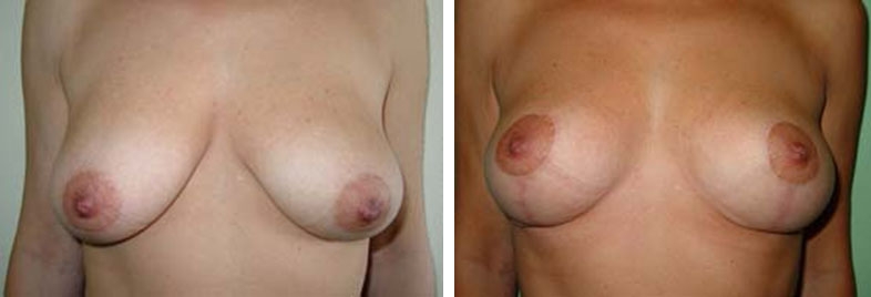 Photo de lifting des seins avant après