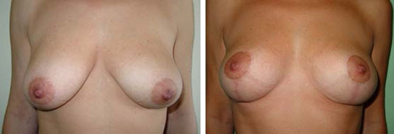 Photo de lifting des seins avant après Photo de lifting des seins avant après