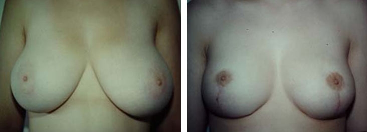 Photo de réduction mammaire avant après