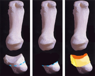 Principe de la chirurgie de la Rhizarthrose par reconstruction articulaire à l'aide d'un greffon cartilagineux