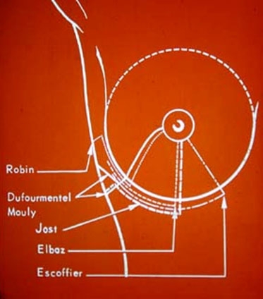 Voies d'abord pour l'hypertrophie mammaire Voies d'abord pour l'hypertrophie mammaire